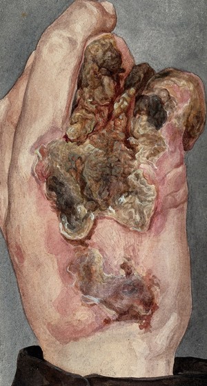 view Lupus vulgaris: an inflamed, infected hand. Watercolour, 1900/1950.