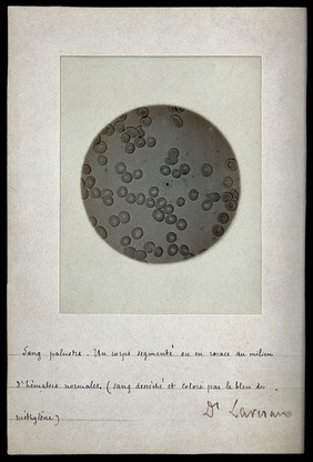 Malarial infection: a cross-section of blood cells (from the work of Alphonse Laveran). Photograph, ca. 1890.