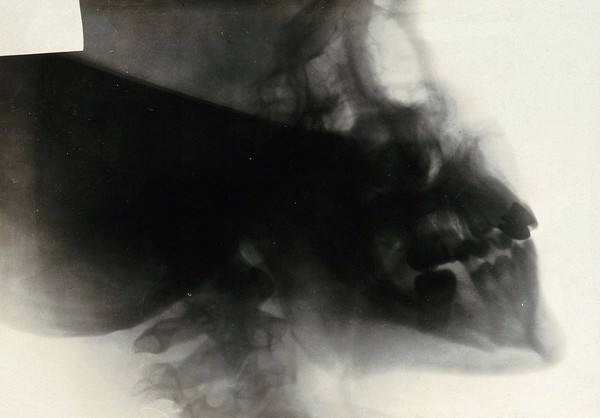 A fractured jaw: x-ray. Photograph, 1914/1918.