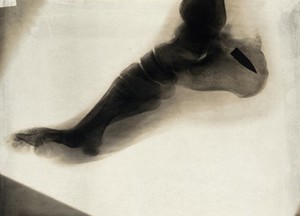 view A machine gun bullet embedded in a foot bone: x-ray. Photograph, 1914/1918.