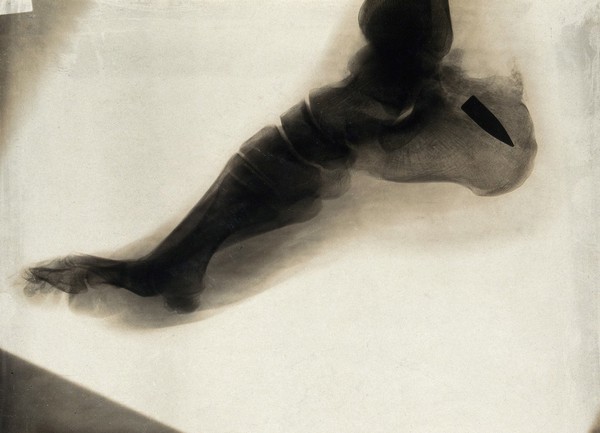 A machine gun bullet embedded in a foot bone: x-ray. Photograph, 1914/1918.