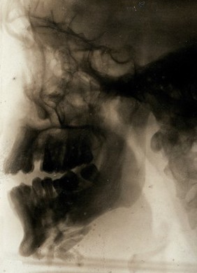 A jaw x-ray. Photograph, 1914/1918.