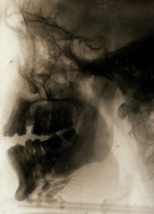 view A jaw x-ray. Photograph, 1914/1918.