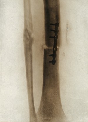 view A leg fracture: showing a plate holding the bone in position: x-ray. Photograph, 1914/1918.