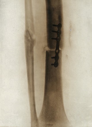 A leg fracture: showing a plate holding the bone in position: x-ray. Photograph, 1914/1918.