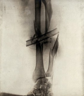 A compound fracture in the arm caused by a bullet, with a drainage tube in place: x-ray. Photograph, 1914/1918.