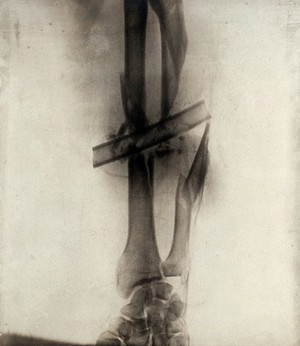 view A compound fracture in the arm caused by a bullet, with a drainage tube in place: x-ray. Photograph, 1914/1918.