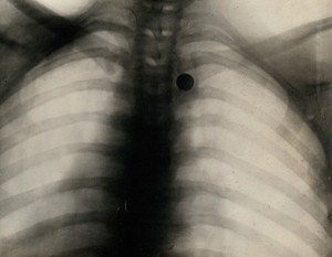 view A shrapnel bullet embedded between a man's ribs: x-ray. Photograph, 1914/1918.