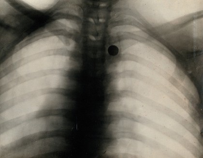 A shrapnel bullet embedded between a man's ribs: x-ray. Photograph, 1914/1918.