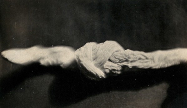 A foetal cord with a figure of eight knot in it. Photograph, 1892.