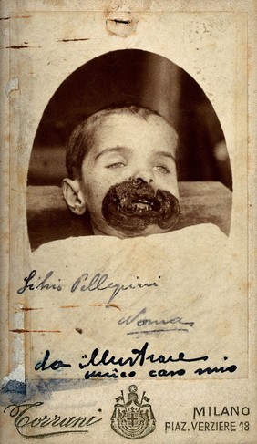 A child suffering from noma (cancrum oris). Photograph by M. Torrani, ca. 1880.