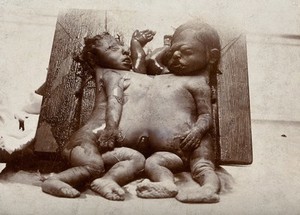 view Conjoined twins (newborn): posthumous. Photograph, 1870/1890.