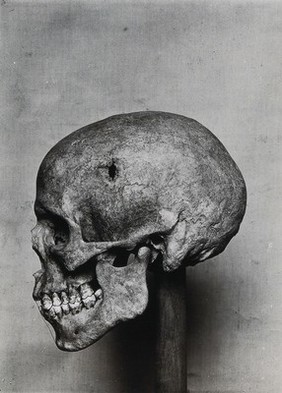 A human skull, with a hole where cranial surgery had been performed. Photograph, ca. 1920, of a photograph, 1900/1920 (?).