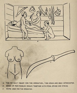 view Caesarean section, Uganda: the patient being prepared for the operation; the sutured wound; the knife used. Ink drawing by S.W. Kelly, 1938, after R.W. Felkin, ca. 1884.