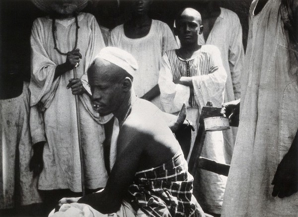 Cupping, using a horn placed on the patient's back, Africa. Photograph by J. Uribe, 1920/1940.