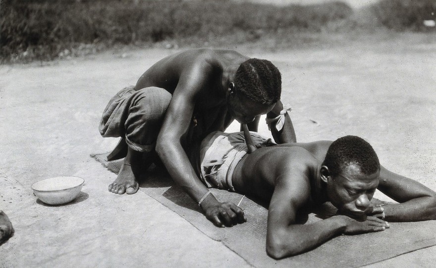 Central African Republic: cupping using a horn which is placed on the patient's lower back and sucked by the medical practitioner who squats over him. Photograph by Antonin Marius Vergiat, ca. 1935.
