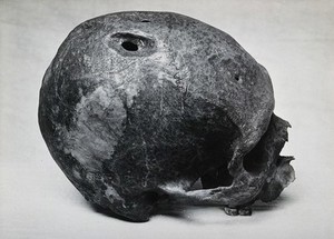 view A trephined human skull. Photograph.