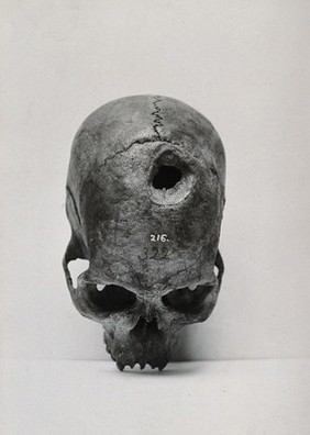 A trephined human skull from New Britain. Photograph, 1940.