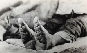 view Feet of a Chinese woman, showing the effect of foot-binding. Photograph, 19--.