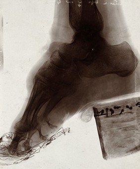 Foot of a Chinese woman, showing the effect of foot-binding. Photograph by (?) E.P. Minett, 192-.