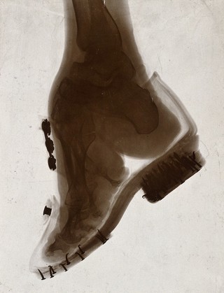 Foot of a Chinese woman, showing the effect of foot-binding. Photograph by (?) E.P. Minett, 192-.