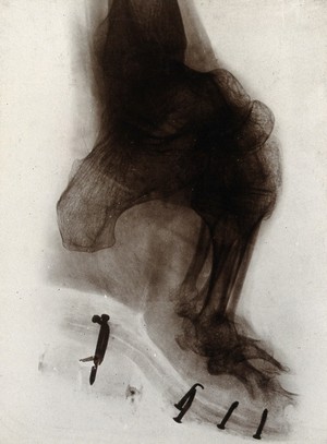 view Foot of a Chinese woman, showing the effect of foot-binding. Photograph by (?) E.P. Minett, 192-.