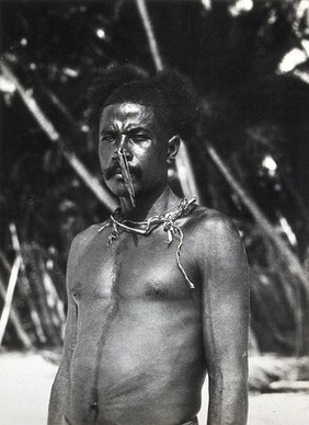 Papua New Guinea (?): a man with a large pin through a hole in his nose. Photograph by E.W. Pearson Chinnery (?).