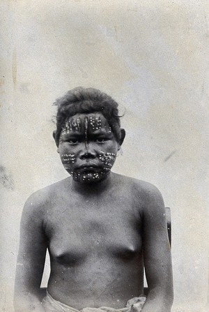 view A young man (?) with elaborate scarification on his face. Photograph.