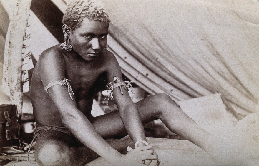 New Georgia, Solomon Islands: a man with his ears distended by heavy earrings. Photograph.
