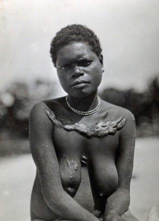 Papua New Guinea (?): a woman with a massive scarification over her clavicles. Photograph by E.W. Pearson Chinnery (?).