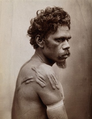 An Aboriginal man with a scarification on his shoulder. Photograph by Henry King, ca. 1890.