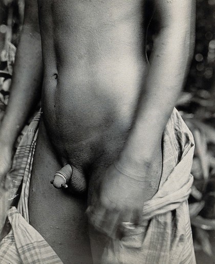 Borneo: a boy with a nail (palang) through his penis. Photograph by Harrison W. Smith.