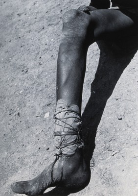 Uganda: the bandaged leg of a member of the Lango tribe, possibly suffering from yaws. Photograph by Cecil John Hackett, ca. 1937.