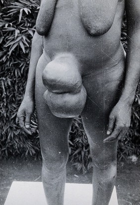 Uganda: a Lango woman with a growth protuding from her navel area. Photograph by Cecil John Hackett, ca. 1937.