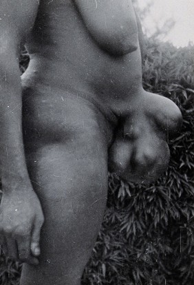 Uganda: a Lango woman with large growths protuding from her navel area. Photograph by Cecil John Hackett, ca. 1937.