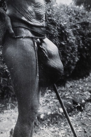 view Uganda: a Lango tribesperson with a large growth in the groin area. Photograph by Cecil John Hackett, ca. 1937.