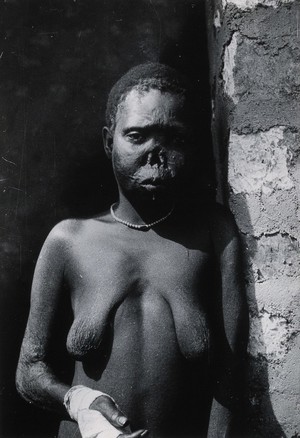 view Uganda: a Lango woman with a disfigured nose, diseased skin and a bandaged hand, possibly suffering from leprosy or yaws. Photograph by Cecil John Hackett, ca. 1937.