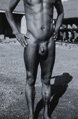 view Uganda: a Lango man with an enlarged scrotum: front view. Photograph by Cecil John Hackett, ca. 1937.