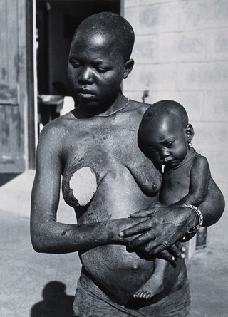 Uganda: a Lango woman with diseased skin holding a baby; she has applied a leaf as a dressing to her swollen left breast. Photograph by Cecil John Hackett, ca. 1937.