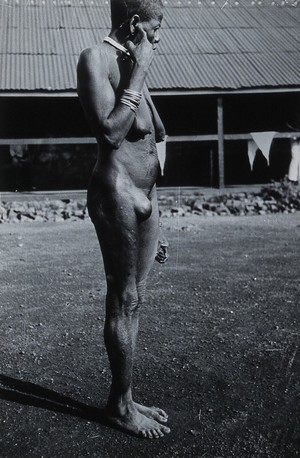 view Uganda: a Lango woman with a growth in her groin area: side view. Photograph by Cecil John Hackett, ca. 1937.