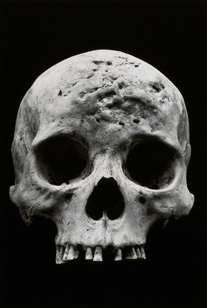 view An Alaskan Inuit skull, showing the effects of syphilis. Photograph by Ales Hrdlicka, ca. 1910.