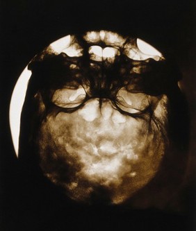 An Alaskan Inuit skull, showing the effects of syphilis. Photograph of x-ray, by A. Hrdlička, ca. 1910.