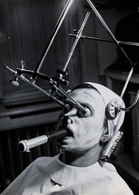 Freckle removal: a woman having a skin peel to remove freckles reclines with a metal contraption positioning her head and a breathing tube in her mouth, Hungary. Photograph by André Just, ca. 1937.