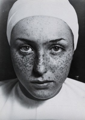 Freckle removal: a woman with freckles on her face prior to having them removed by a skin peel. Photograph by André Just, ca. 1937.