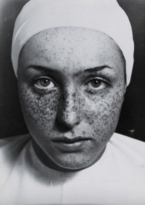 view Freckle removal: a woman with freckles on her face prior to having them removed by a skin peel. Photograph by André Just, ca. 1937.