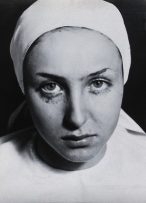 view Freckle removal: a woman's face following a skin peel to remove her freckles; a few remain around the eye area. Photograph by André Just, ca. 1937.