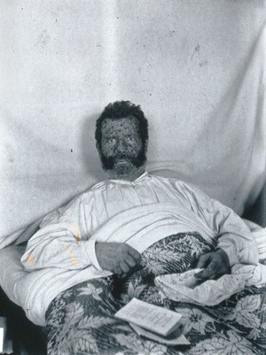 view Gloucester smallpox epidemic, 1896: George Allen, a smallpox patient. Photograph by H.C.F., 1896.