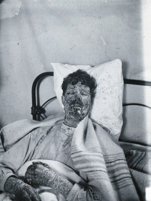 view Gloucester smallpox epidemic, 1896: Edwin Davis, a smallpox patient. Photograph by H.C.F., 1896.