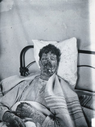 Gloucester smallpox epidemic, 1896: Edwin Davis, a smallpox patient. Photograph by H.C.F., 1896.