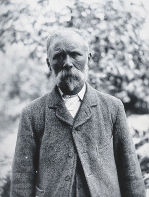 view Gloucester smallpox epidemic, 1896: George Steel, a smallpox patient. Photograph by H.C.F., 1896.